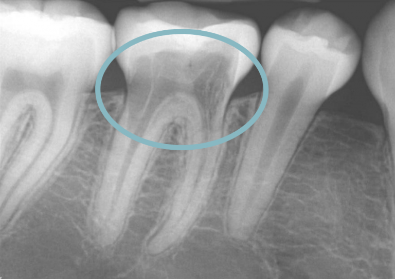 xray of baby teeth