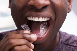 Man Adjusting Transparent Aligners In His Teeth