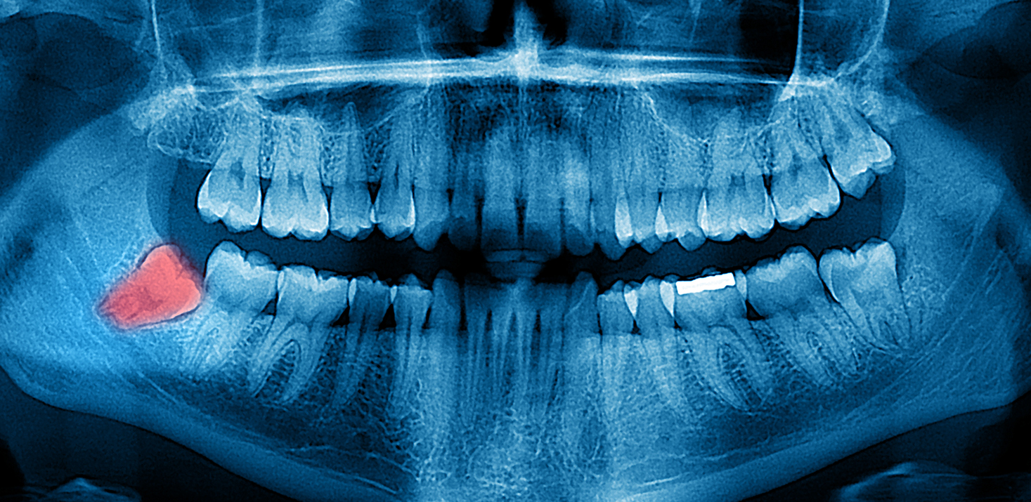 Dental X-Ray panoramic
