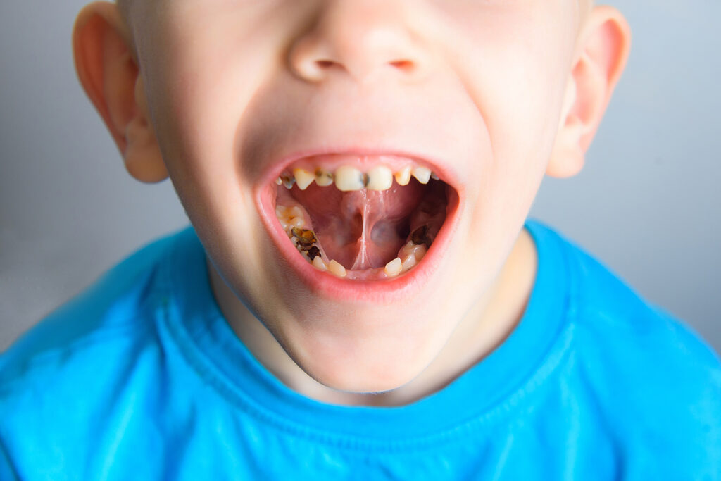 Caries on the teeth of a young child