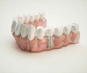 Dental-Implant by Dentist in Port Angeles