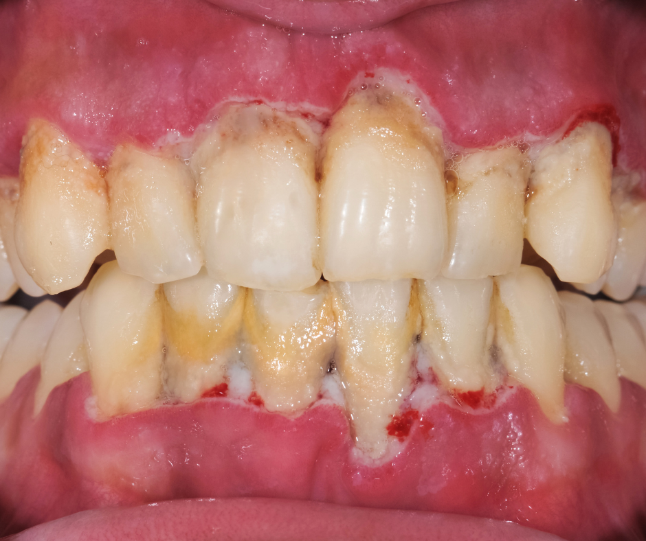 periodontal disease need dental care immediately